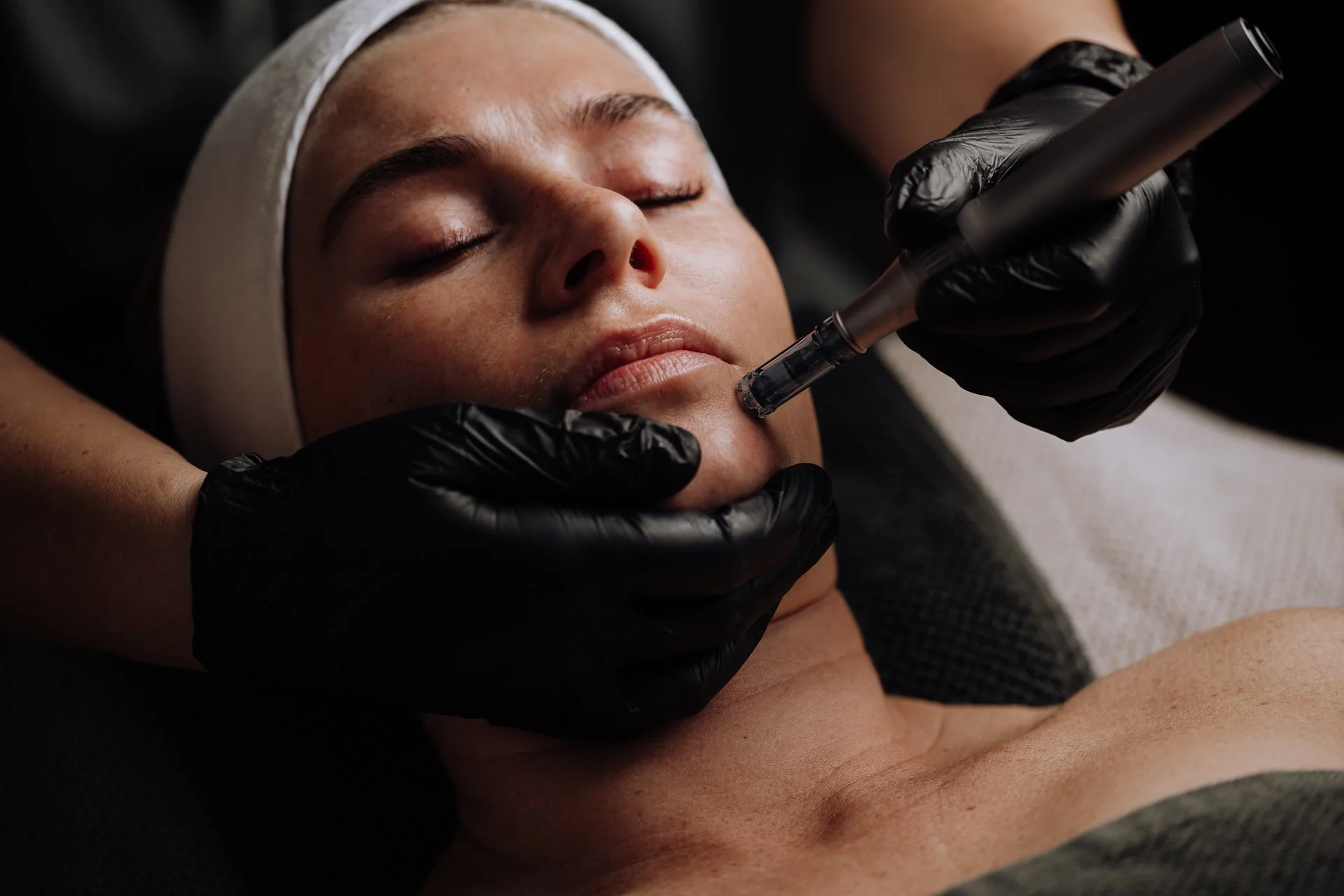 Microneedling treatment